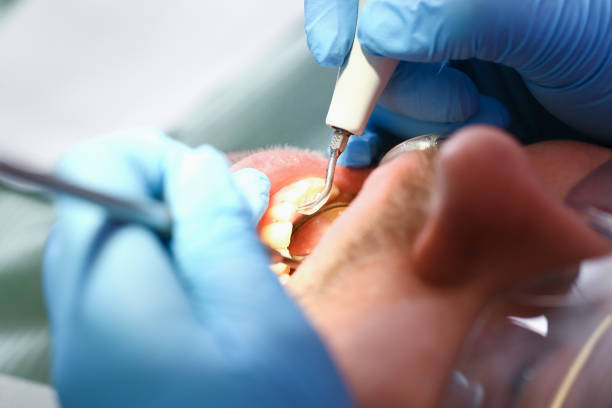Best Emergency Root Canal Treatment in Tuskegee, AL